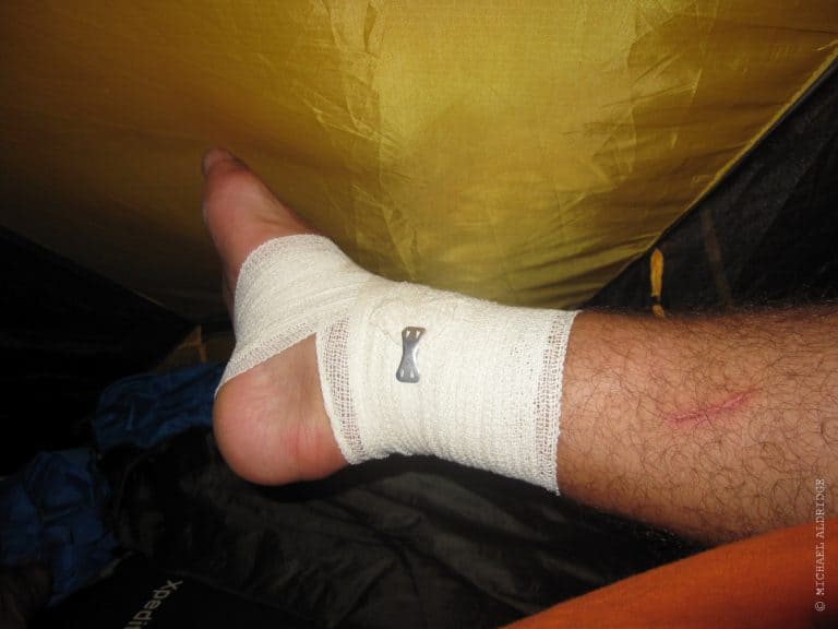 Ankle Injury during the bike trip